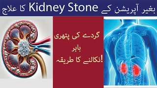 Kideny Stones ko Kaise Nikala Jae  How to Remove Kidney Stones  Removal Of Kidney Stones [upl. by Dnomsad]