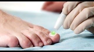 Fungal Toenail Treatment With Lunula Laser® At Atlas Podiatry [upl. by Ardle]