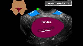 POCUS Female Pelvis Transvaginal Scanning Sequence [upl. by Lecia]