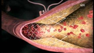 Arteriosklerose  Stent oder Bypass [upl. by Nave828]