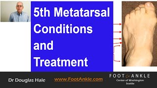 5th Metatarsal Conditions  Seattle Podiatrist [upl. by Llebana373]