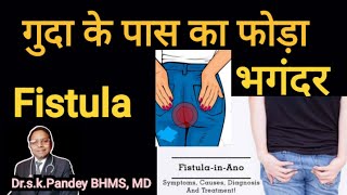 fistula की सबसे अच्छी होमियोपैथिक दवापहले दिन से ही असर दिखेगा। Dr skPandey BHMSMD [upl. by Eisyak723]