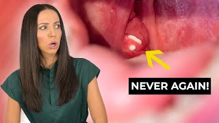 How to PREVENT Tonsil Stones [upl. by Wengert]