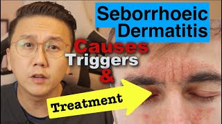 Seborrhoeic Dermatitis  Causes Triggers amp Treatment Options [upl. by Atinomar]