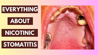 Nicotinic Stomatitis Explained Causes Symptoms and Treatment Options  InDepth Lecture [upl. by Gerhardt]