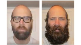 THICKEST BEARD 6 MONTH TIMELAPSE [upl. by Tresa889]