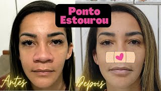 Rinosseptoplastia 💗SUS💗 Nariz Negroide Pré operatório  Pós operatório 6 meses depois [upl. by Bibby887]