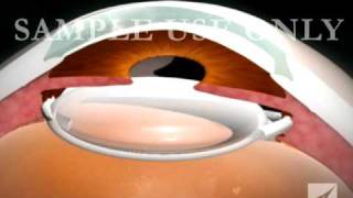 Eye Surgery Cataract with Lens Replacement [upl. by Anyad]