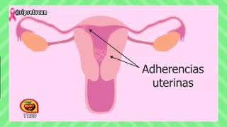 LEGRADO UTERINO y SINDROME DE ASHERMAN DRORIOL OLIVERA GINECÓLOGO DE AMECAE [upl. by Morentz]