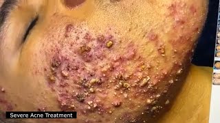 BEST BLACKHEAD AND WHITEHEAD REMOVAL SEVERE ACNE TREATMENT  SATISFYING AND RELAXING VIDEO [upl. by Giusto449]