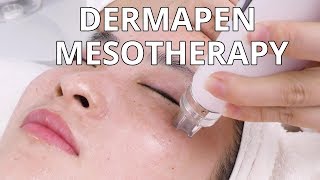 Dermapen Mesotherapy  How Microneedling Treatment Is Done  NV6130 MYCHWAY VIDEO [upl. by Silado]