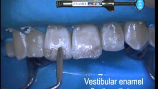 Enamel Plus HRi kerrostusvideo Dr Lorenzo Vanini ENA HRi Kompodent [upl. by Petra]