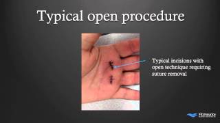 EndoTech® Endoscopic Trigger Finger Release  Fitzmaurice Hand Institute  Phoenix Arizona [upl. by Kamin]