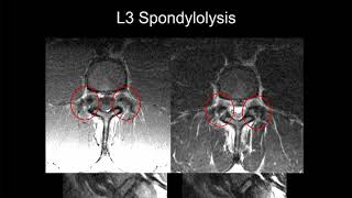 MRI of the Lumbar Spine  Part 9  Lumbar Trauma [upl. by Andi]