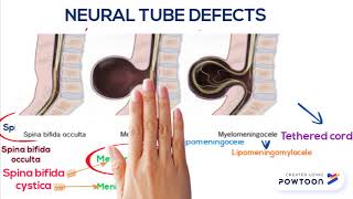 Neural tube defect Neural tube defect [upl. by Emmalee36]