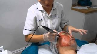 DERMAPEN Skin Needling For Acne Scarring [upl. by Bultman32]