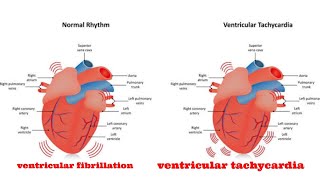 ventricular fibrillation and pulseless ventricular tachycardia [upl. by Onil]