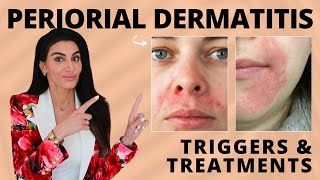 Perioral Dermatitis Triggers amp Treatment Recommendations by a Dermatologist [upl. by Sokul]