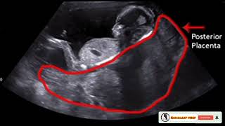 Baby Gender and placenta Positions in pregnancyPlacenta on Ultrasound [upl. by Jordon]