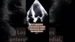 Hipoquinesia anterolateral medial y apical echocardiogram hipoquinesia akinesia infarto [upl. by Guilbert881]