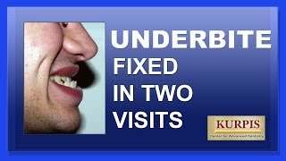 Fix Underbite Without Orthognathic Surgery [upl. by Droffats239]