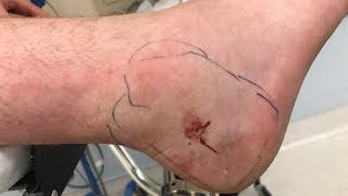 Man bitten by copperhead snake at Lake Needwood [upl. by Inalan]