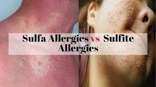 Sulfa Allergies vs Sulfite Allergies [upl. by Crisey248]