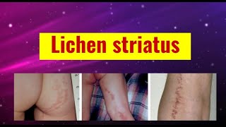 Lichen striatus overview causes features histology and management [upl. by Ramel]