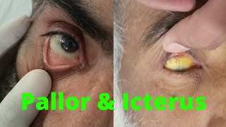 PALLOR and ICTERUS in EYE  ANEMIA and JAUNDICE in eye examination [upl. by Ahsam]