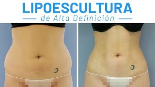 Lipoescultura Váser de Marichu del Amo DIRECTO  Lipotransferencia a Glúteos [upl. by Shadow896]