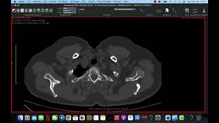 ANATOMIA NA TOMOGRAFIA DE TÓRAX [upl. by Notyrb]