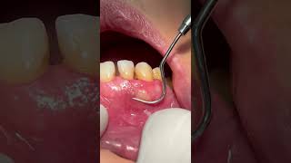 Perioindo lesion tooth inflammation dental [upl. by Anaxor]