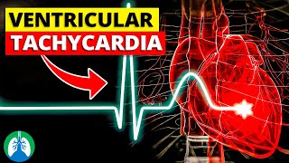 Ventricular Tachycardia Vtach  Medical Explainer Video [upl. by Iruam]