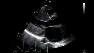 Restrictive Cardiomyopathy  Transthoracic Echocardiogram TTE [upl. by Tiffanle55]