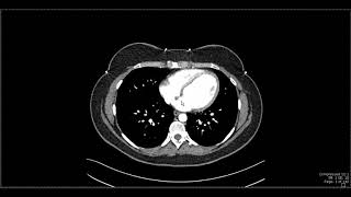 Abdominal Anatomy on Computed Tomography [upl. by Eittel]