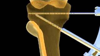 Intervento di osteotomia [upl. by Ietta]