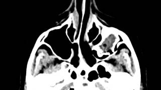 Odontogenic Ossifying Fibroma [upl. by Kutchins]