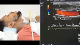 Carotid and Vertebral Arteries Doppler Ultrasound Protocols [upl. by Annairb]