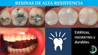 Resinas dentales de alta resistencia [upl. by Acima536]