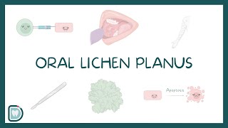 Oral Lichen Planus Causes Diagnosis Types and Management [upl. by Jansen]