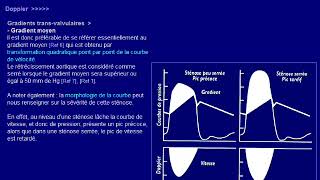 rétrécissement aortique [upl. by Einwat]