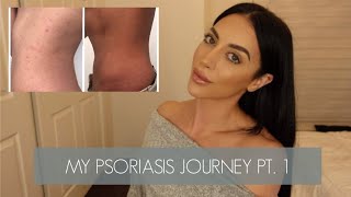 PSORIASIS JOURNEY PT 1  HOW I CLEARED MY PSORIASIS AND GOT MY LIFE BACK [upl. by Dachy132]