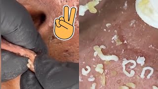 Big Cystic Acne Blackheads Extraction Blackheads amp Milia Whiteheads Removal Pimple Popping [upl. by Eerized862]