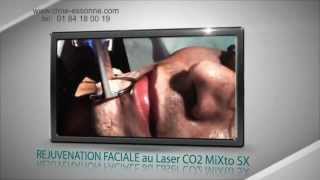 REJUVENATION FACIALE au Laser CO2 Micro Fractionné MiXto SX  CLME Montlhéry Essonne [upl. by Neenaej]