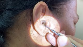 Massive Hard Dry Earwax Removed from Womans Ear [upl. by Hilaire824]