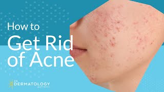 Acne Treatment  Explained by Dermatologist [upl. by Nrubloc429]