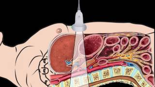 Introduction Abdominal Aorta Focused Ultrasound Examination [upl. by Otilrac]