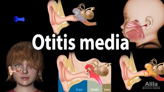 Otitis Media Anatomy Pathophysiology Risk Factors Types of OM Symptoms and Treatment Animation [upl. by Ysnil]