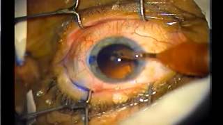 Cataract Surgery in 6 minutes Narrated DrSibley  wwwMarkSibleyMDcom [upl. by Luht874]