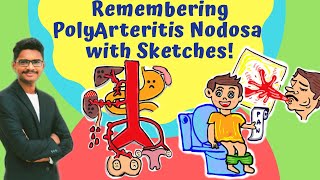 POLYARTERITIS NODOSA IN 4 MIN  THE MUST KNOW PART MNEMONICS SKETCHIFIED  NEETPG  DRKARTHIKEYAN [upl. by Kano]